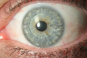 resultat-pose-implant-oculaire