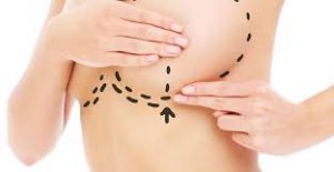 lifting-mammaire-tunisie