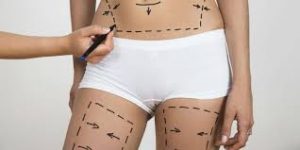 lipoaspiration-tunisie