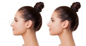 Rhinoplastie-Tunisie