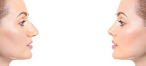 rhinoplastie-tunisie