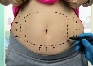 abdominoplastie