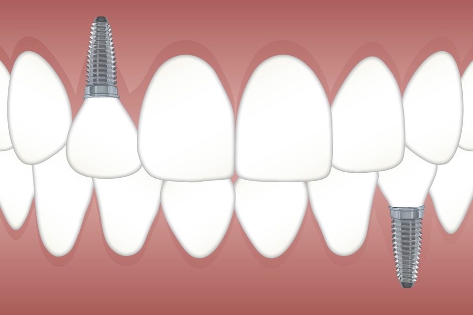 implant-dentaire-machoire-complete