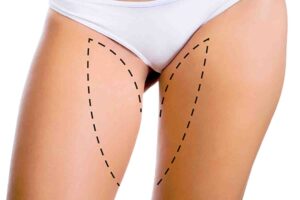 prix-reduction-cuisses-turquie