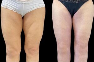 resultat-reduction-cuisses-avant-apres