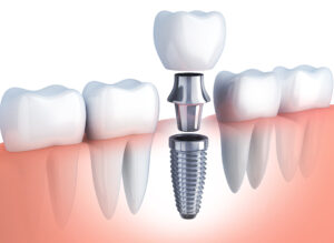 Implant-dentaire-prix-turquie