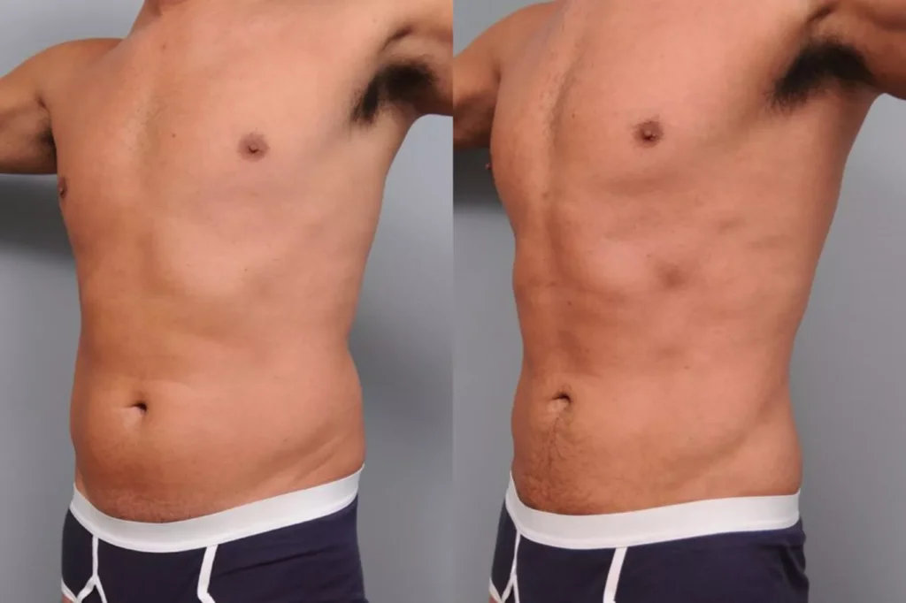resultat-smartlipo-turquie