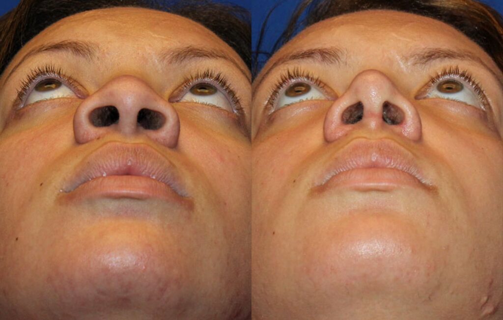 rhinoplastie-ethnique-afro